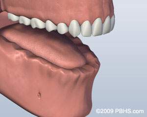 lower-jaw-all-teeth-missing-before-ball-attachment-denture