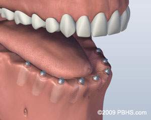 lower-jaw-all-teeth-missing-with-six-implants-for-screw-attachment-denture