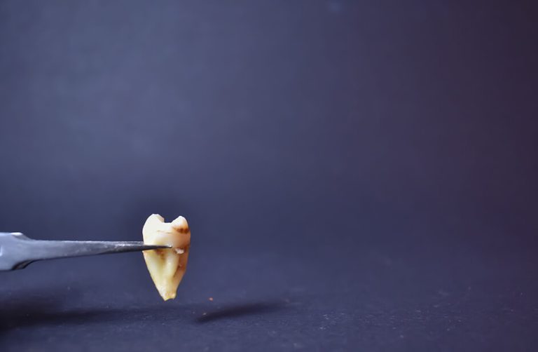 Dental Trauma