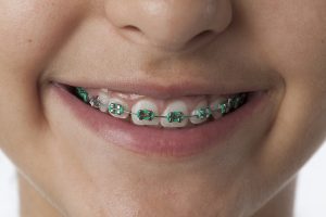 Post-Braces Care