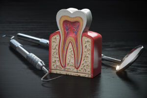 Root Canal