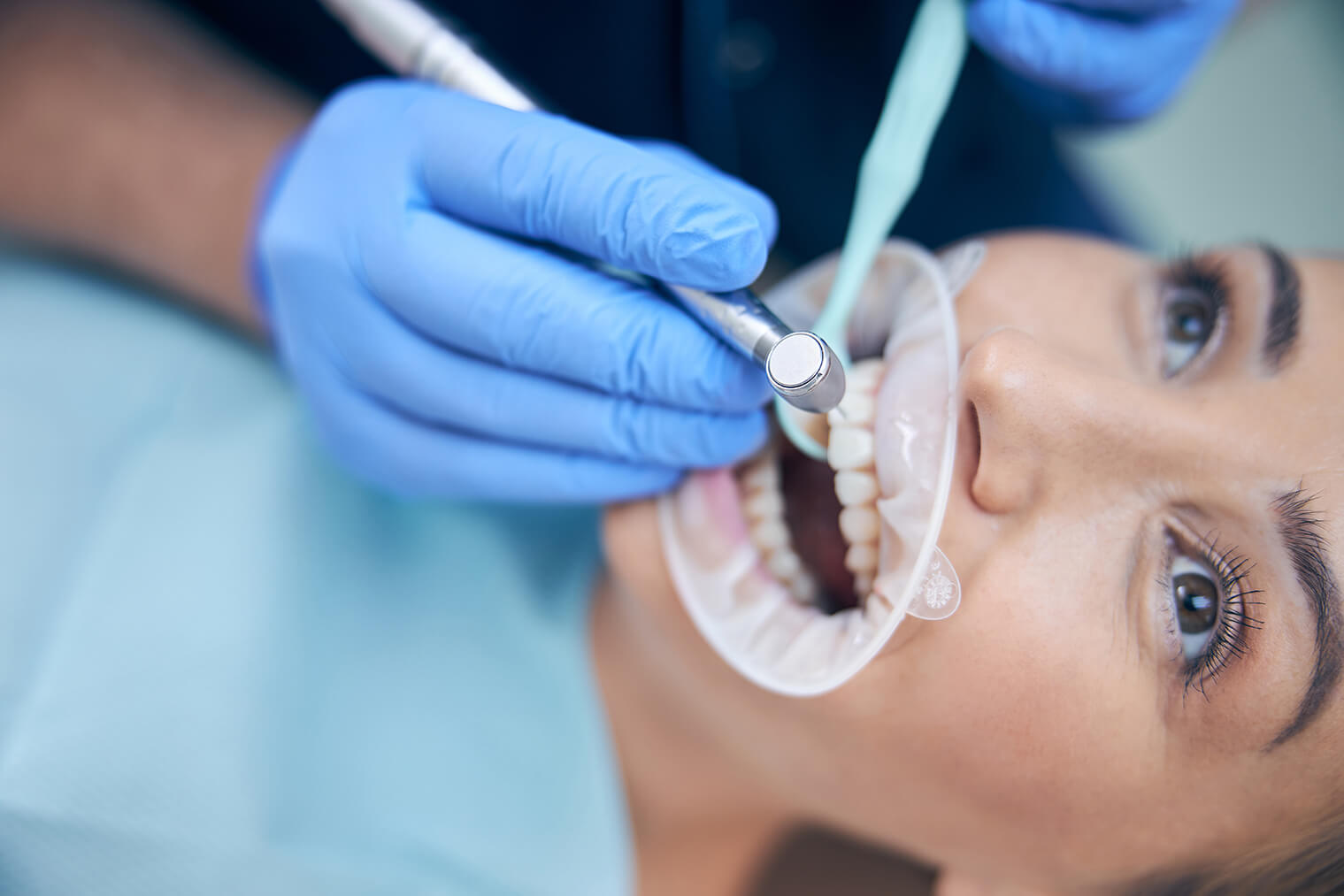Dental Sealants