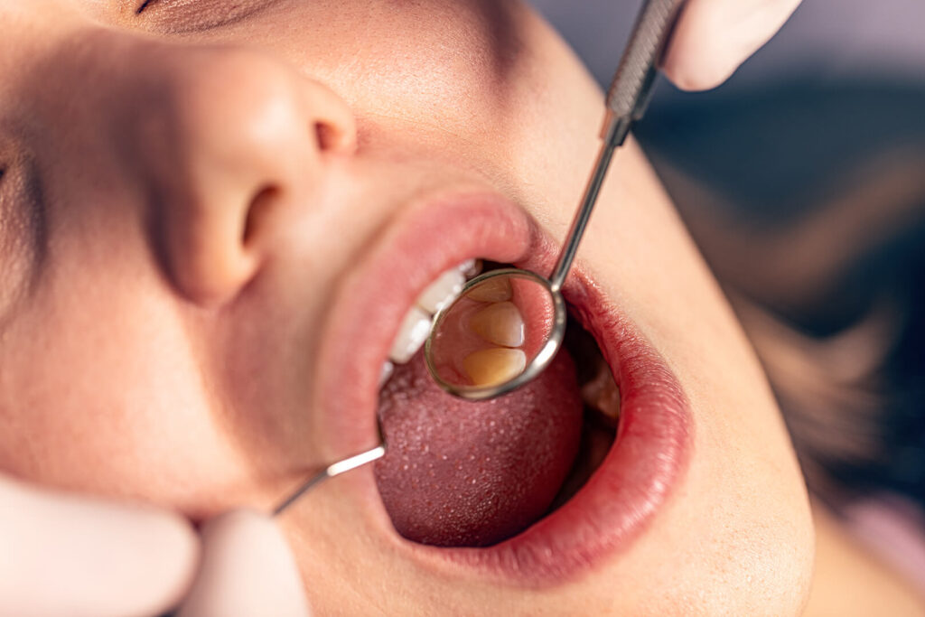 Cavity Prevention