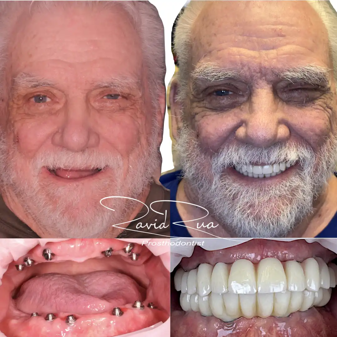 Patient #1( All on 6 hybrids).001 copy