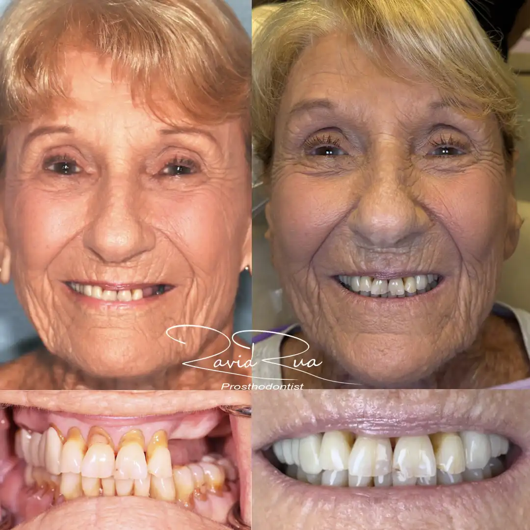 Patient #10( Bridge supported by 4 implants) .001 copy