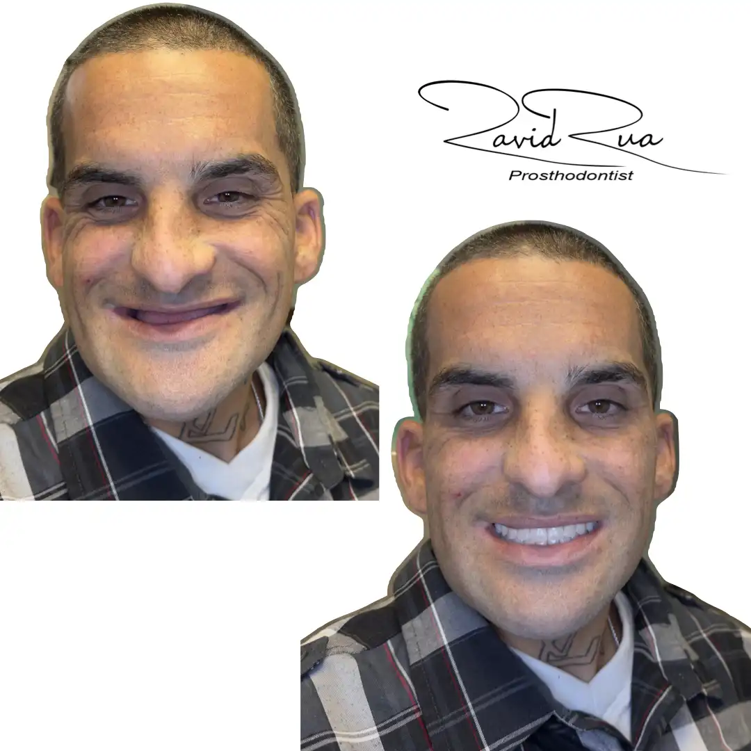 Patient #11( Dentures ).001 copy