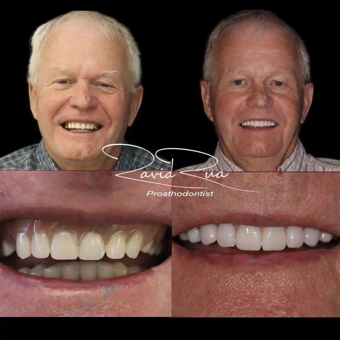 Patient #12 Top Titanium bar Overdenture and bottom Overdenture on 4 implants .001 copy