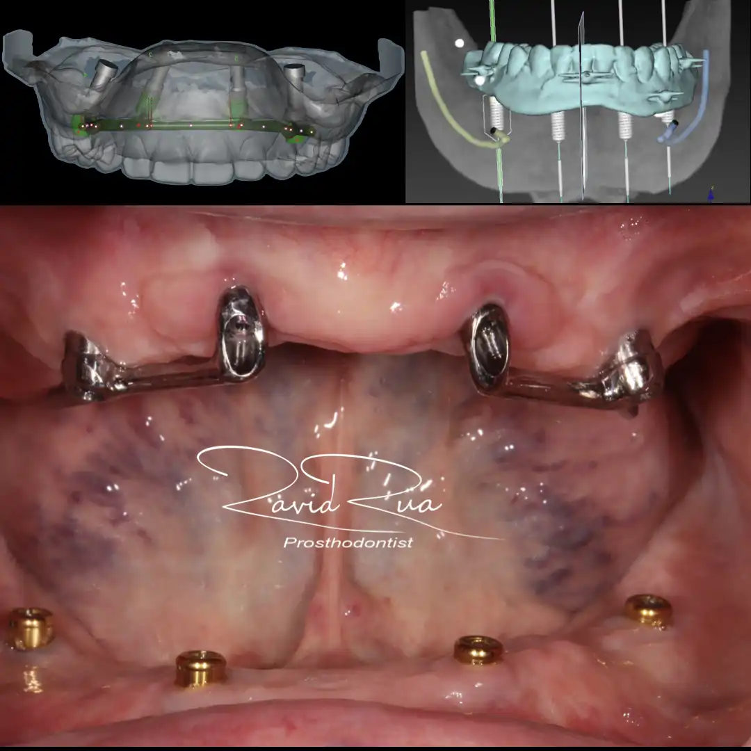 Patient #12 Top Titanium bar Overdenture and bottom Overdenture on 4 implants .002 copy