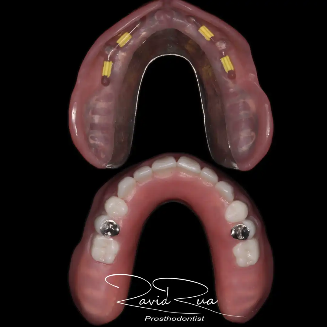 Patient #12 Top Titanium bar Overdenture and bottom Overdenture on 4 implants .003 copy