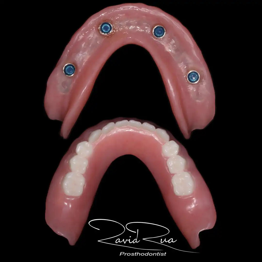 Patient #12 Top Titanium bar Overdenture and bottom Overdenture on 4 implants .004 copy