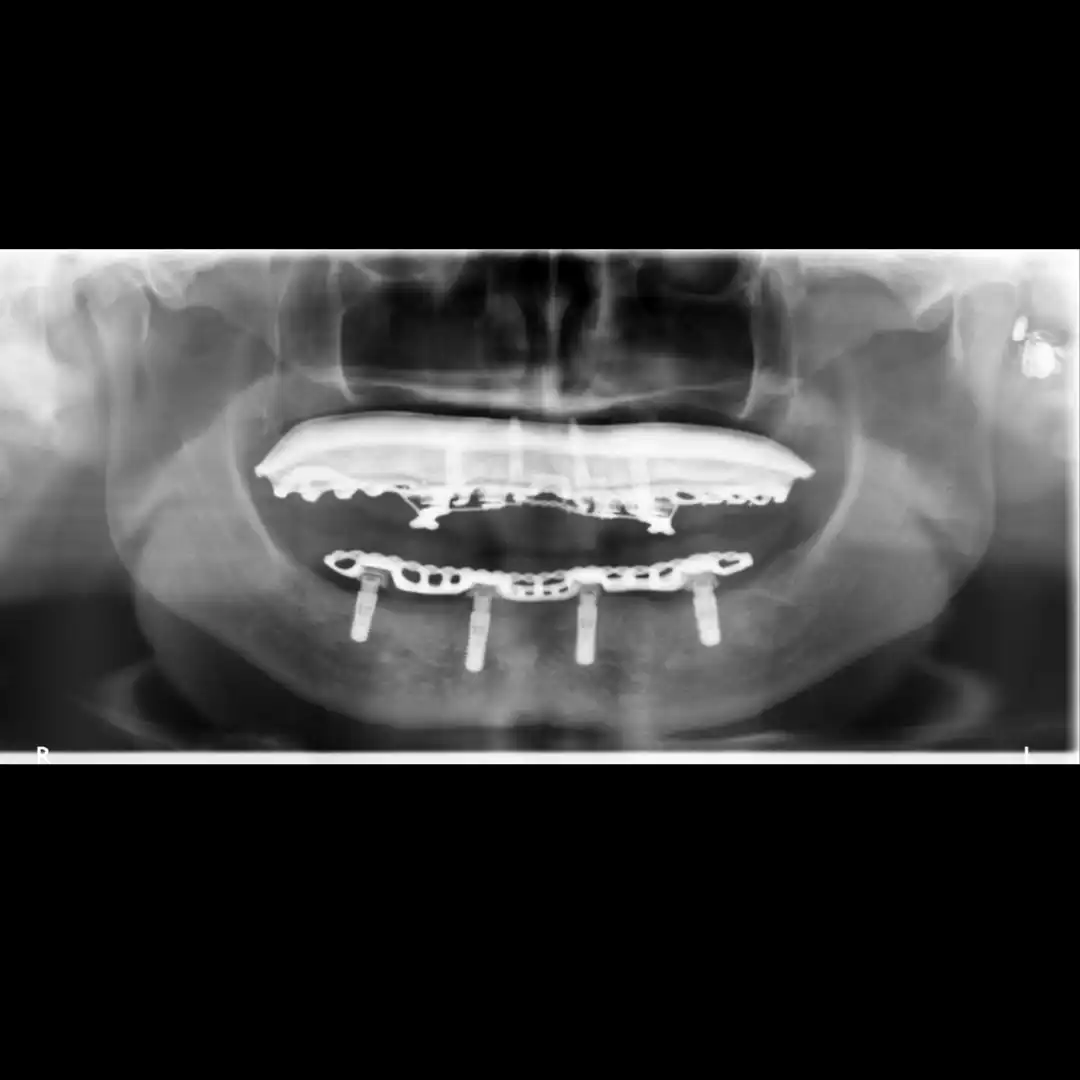 Patient #12 Top Titanium bar Overdenture and bottom Overdenture on 4 implants .005 copy