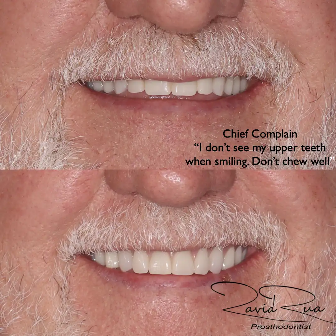 Patient #13( Dentures).001 copy