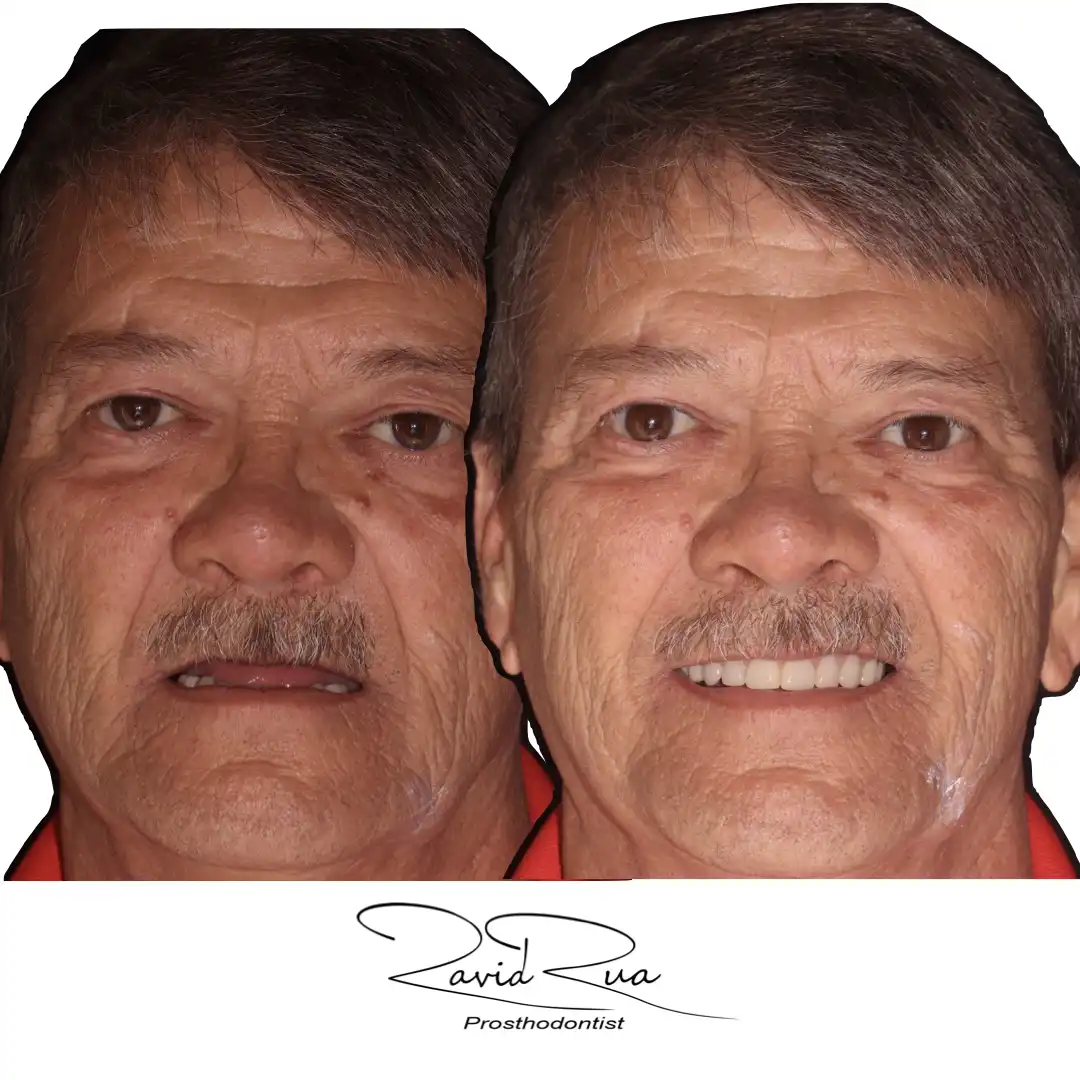 Patient #14 ( All on 5 hybrids).001 copy