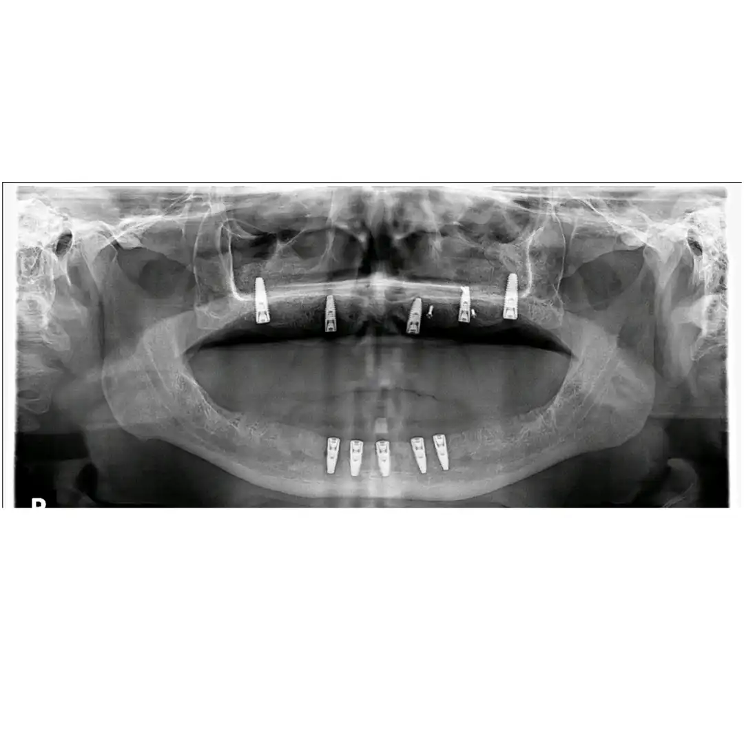 Patient #14 ( All on 5 hybrids).002 copy