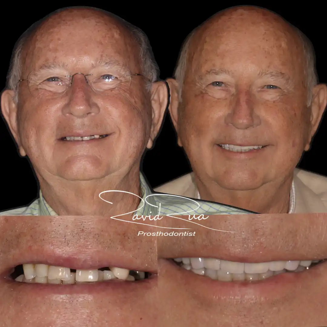 Patient #15( Ceramic and gold crowns. Partial prosthetis assisted by 3 implants).001 copy