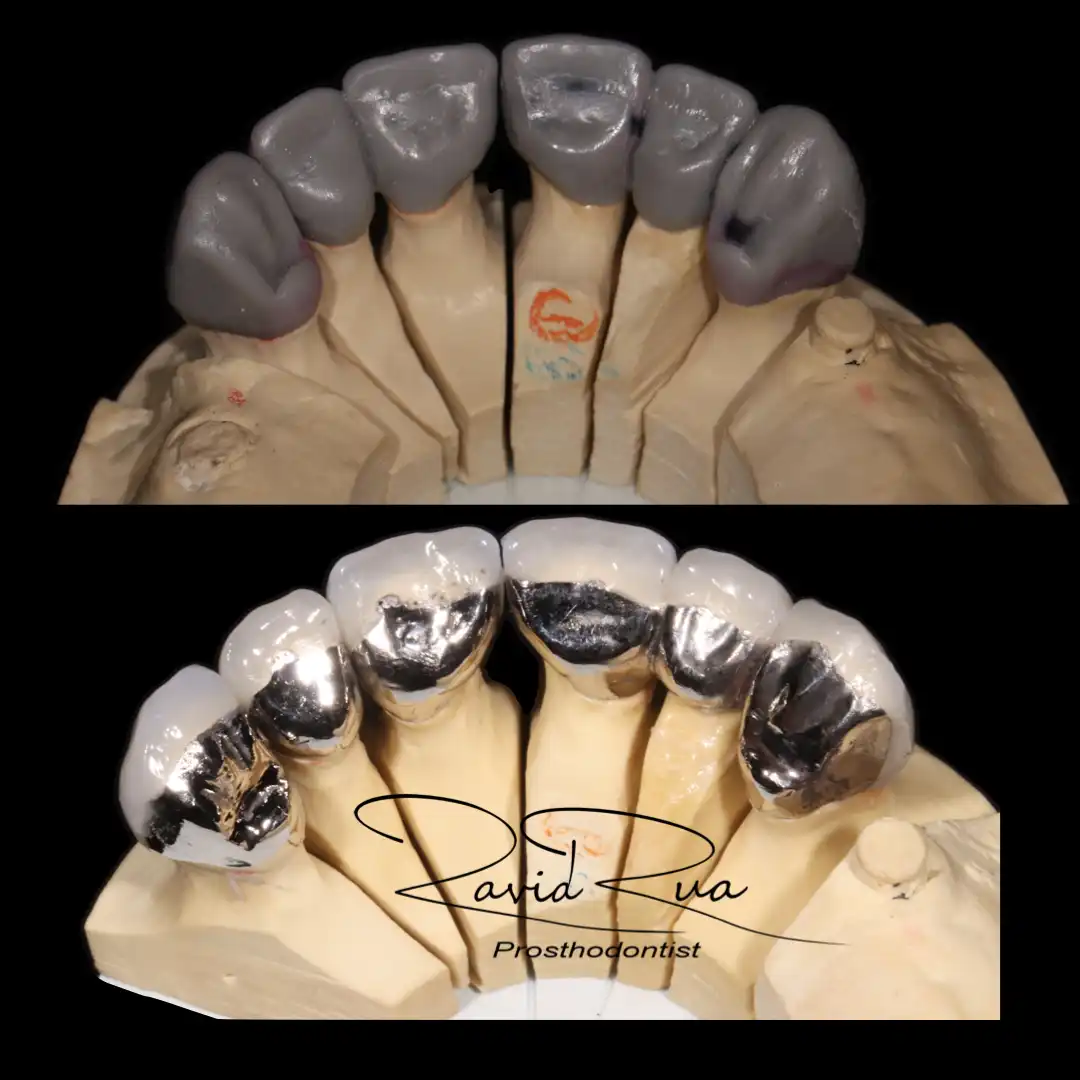 Patient #15( Ceramic and gold crowns. Partial prosthetis assisted by 3 implants).002 copy
