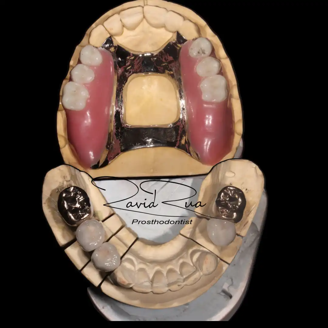 Patient #15( Ceramic and gold crowns. Partial prosthetis assisted by 3 implants).003 copy