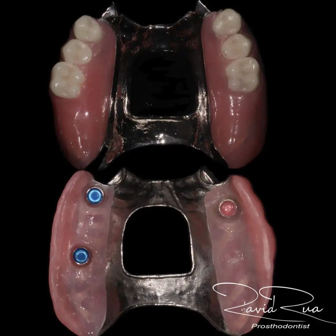 Patient #15( Ceramic and gold crowns. Partial prosthetis assisted by 3 implants).004 copy