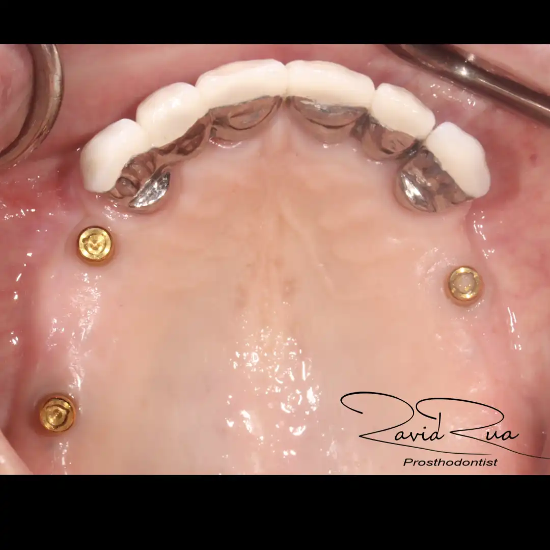 Patient #15( Ceramic and gold crowns. Partial prosthetis assisted by 3 implants).005 copy