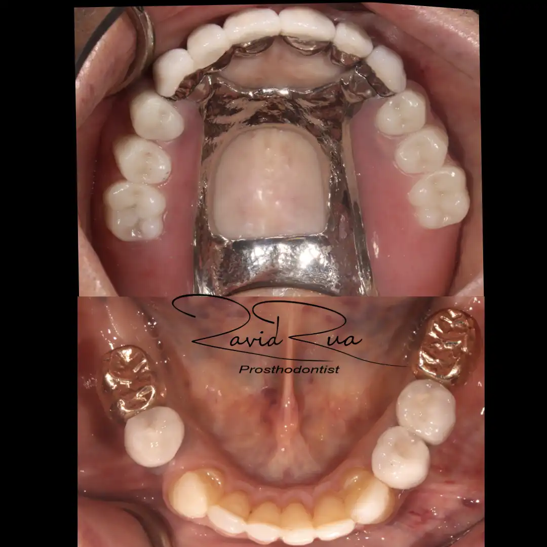 Patient #15( Ceramic and gold crowns. Partial prosthetis assisted by 3 implants).006 copy