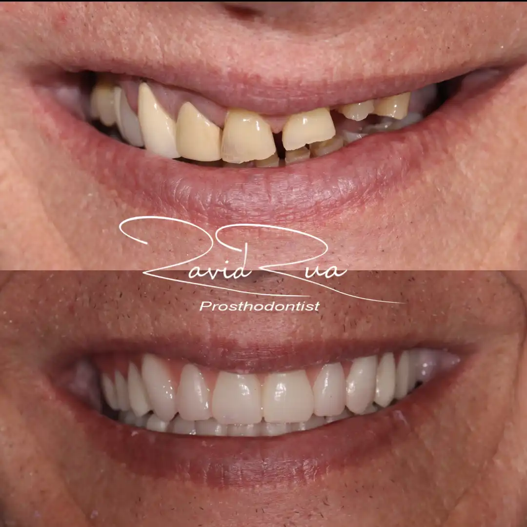 Patient #16( Dentures with natural appearance ).001 copy