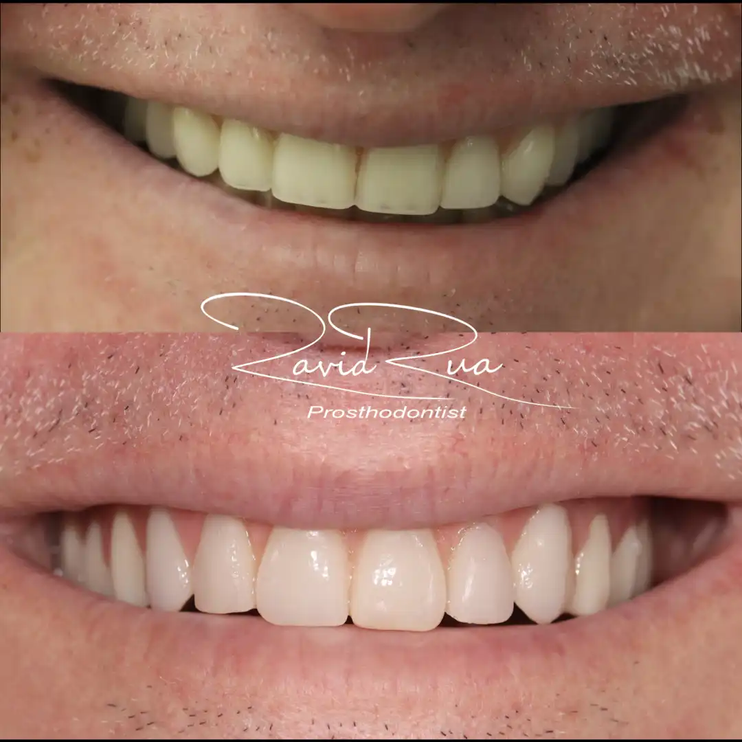 Patient #17( Top Telescopic restoration on 6 Implants) .001 copy