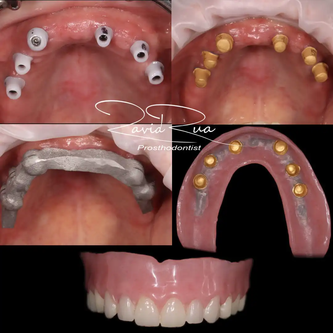 Patient #17( Top Telescopic restoration on 6 Implants) .002 copy
