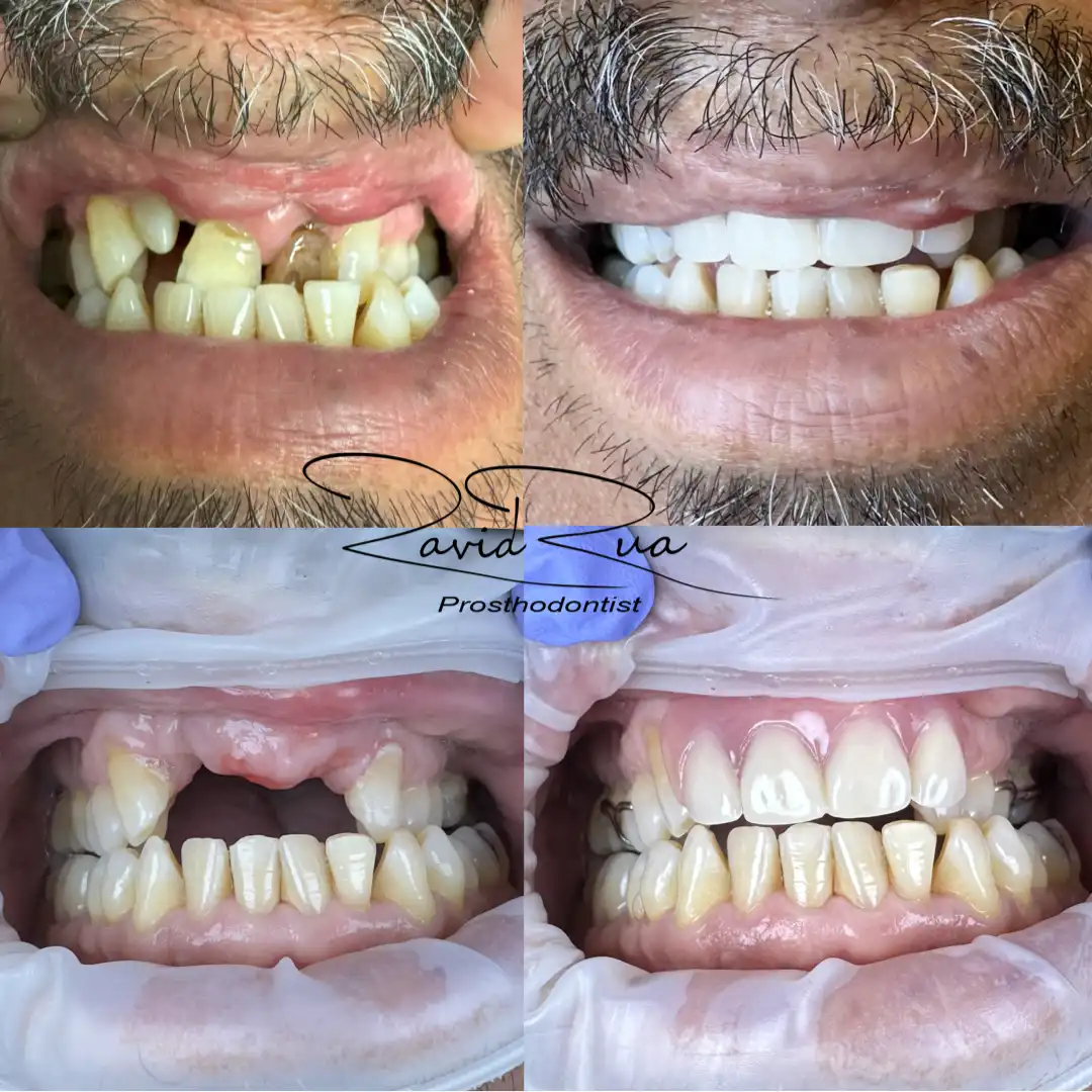 Patient #18( Top Partial for a patient with cleft lip and palate).001 copy