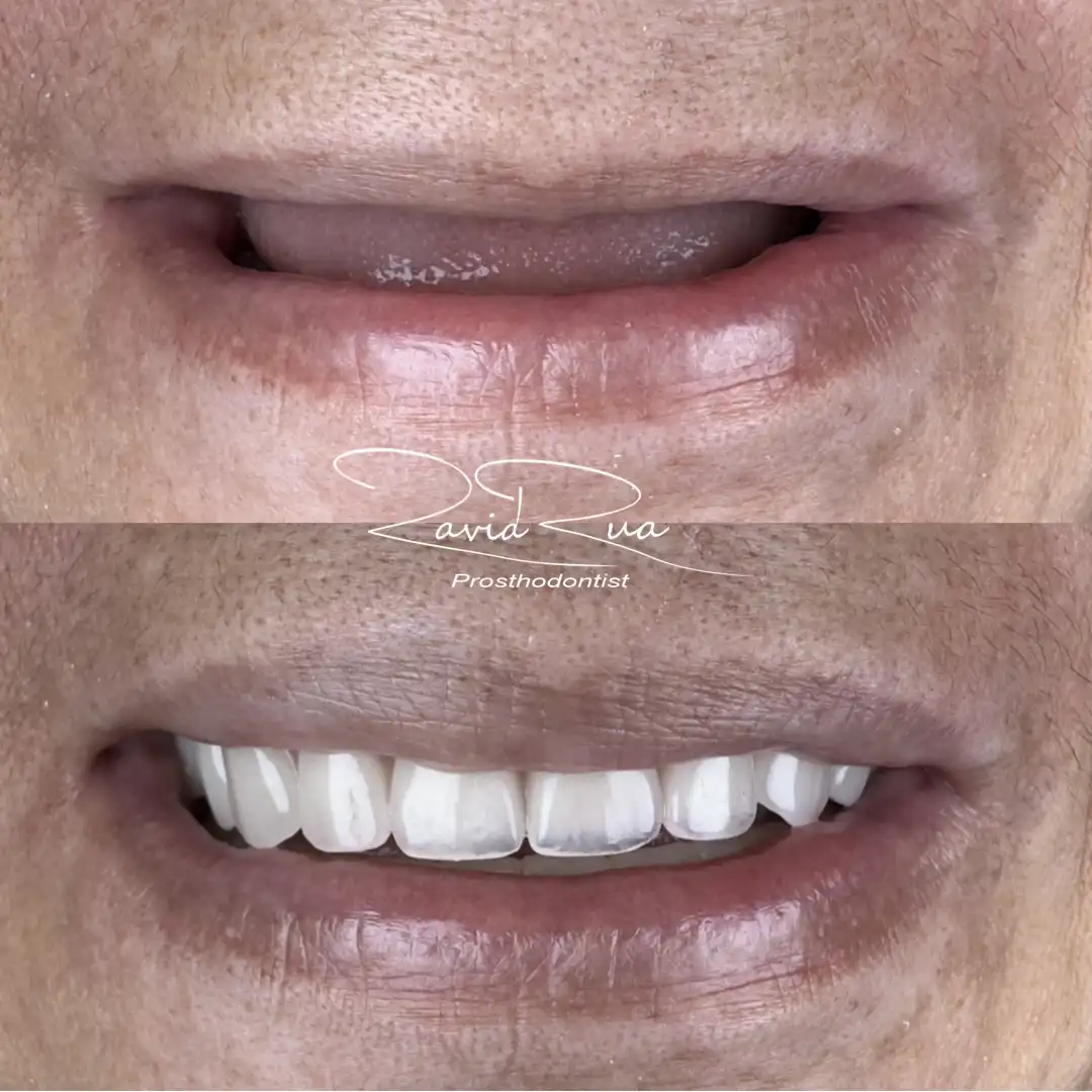 Patient #19( Overdenture on 4 implants in a patient with Facial Paralysis).001 copy