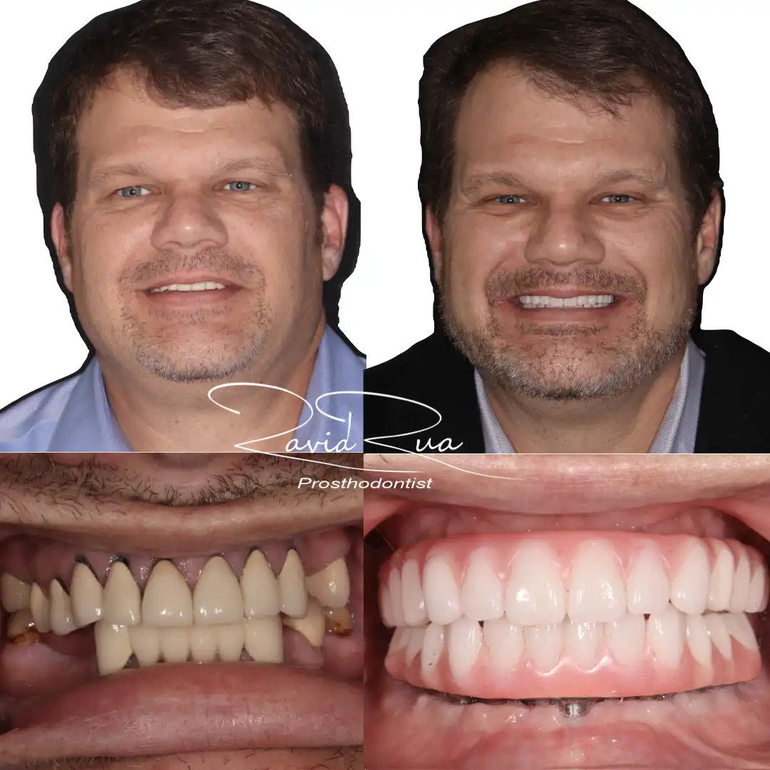 Patient #2( All on 5 and 7 hybrids).001 copy