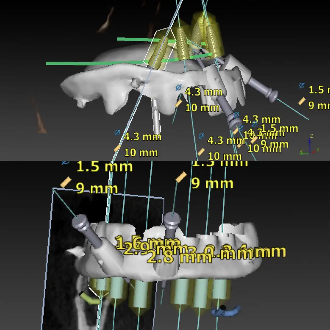 Patient #2( All on 5 and 7 hybrids).002 copy