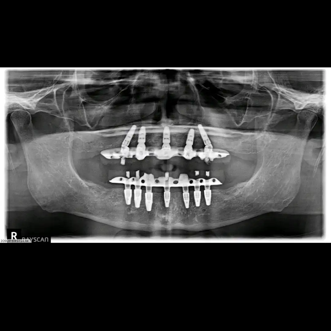 Patient #2( All on 5 and 7 hybrids).003 copy