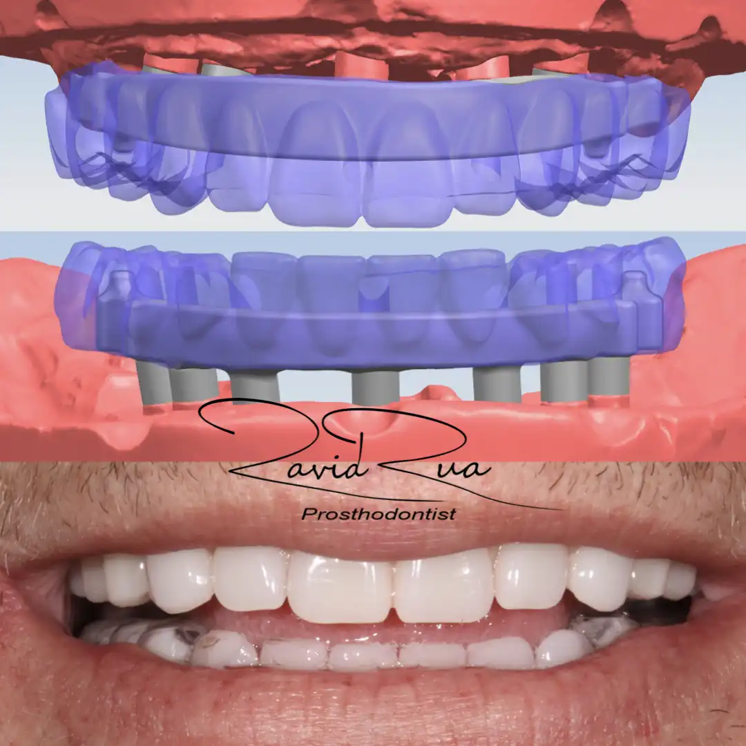 Patient #2( All on 5 and 7 hybrids).004 copy