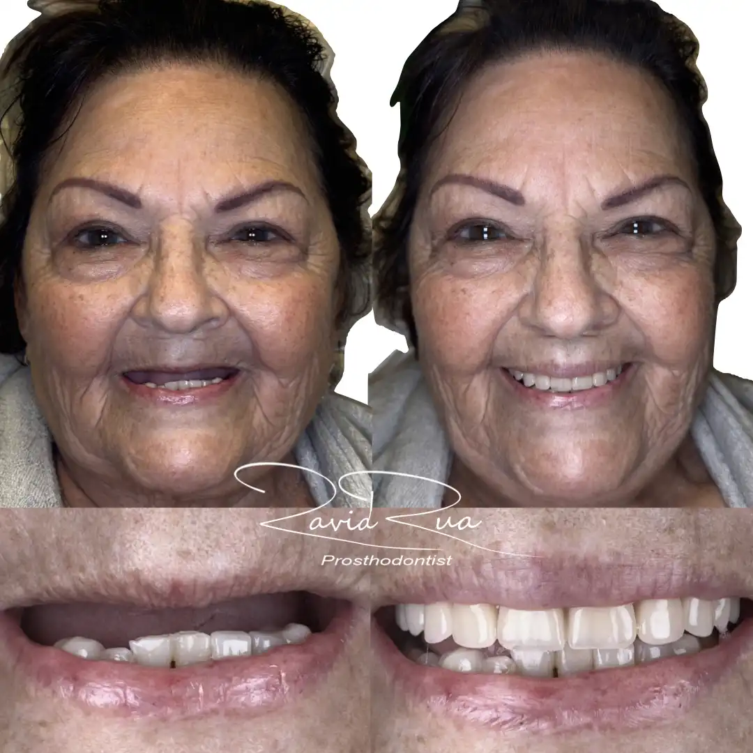 Patient #20( Upper Complete Denture ) .001 copy