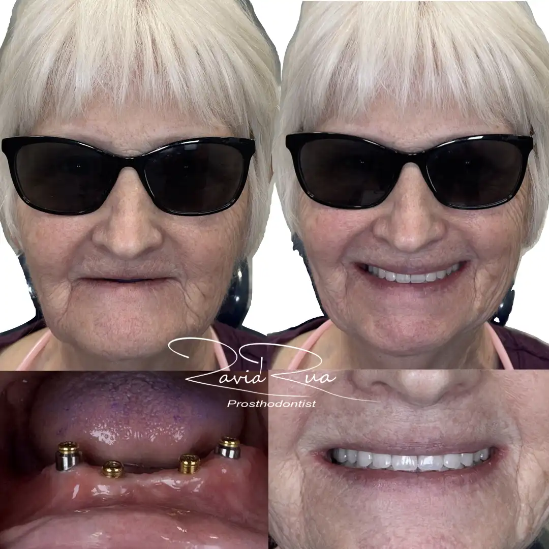 Patient #3( Top Denture and bottom Overdenture with 4 implants ) .001 copy