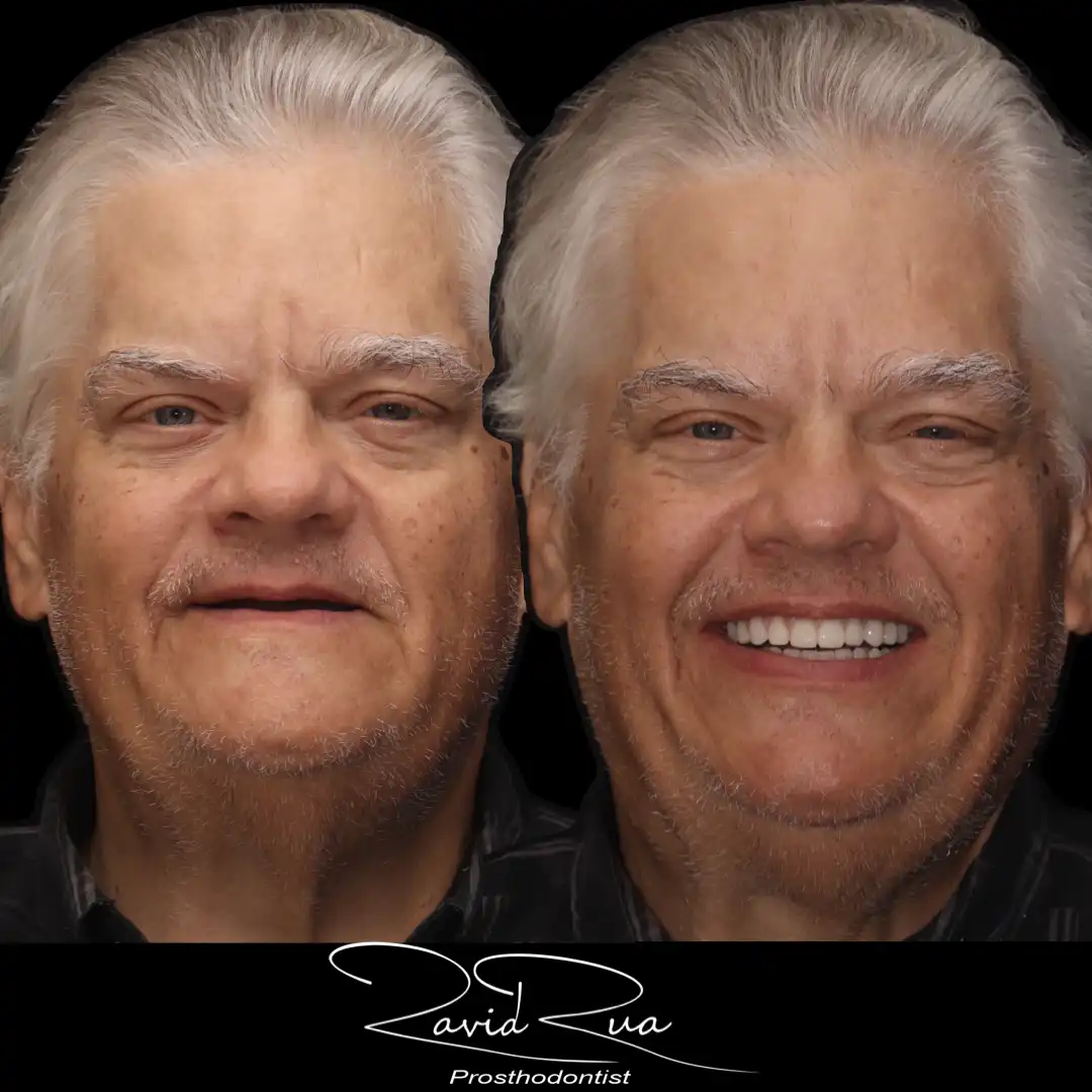 Patient #4( Top All on 5 hybrid and bottom Telescopic prosthesis .001 copy