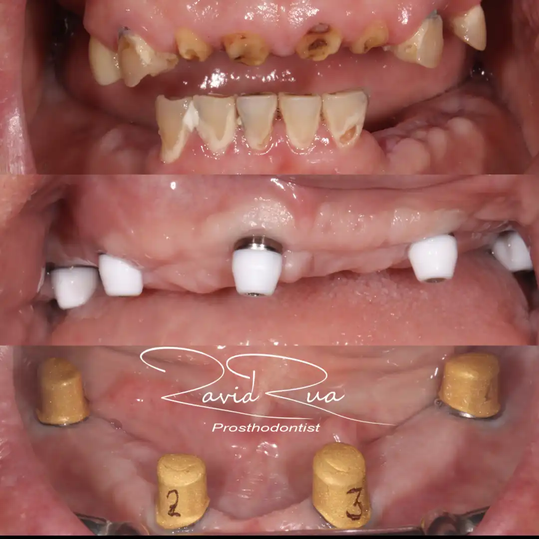 Patient #4( Top All on 5 hybrid and bottom Telescopic prosthesis .002 copy
