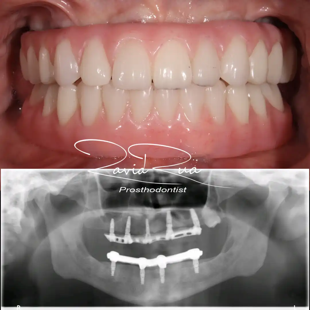 Patient #4( Top All on 5 hybrid and bottom Telescopic prosthesis .003 copy