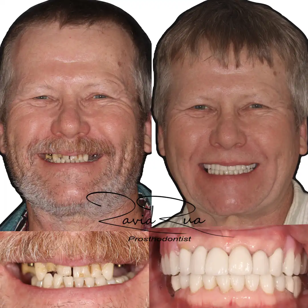 Patient #5(Top Partial Prosthesis supported by 4 implants and new crowns .001 copy