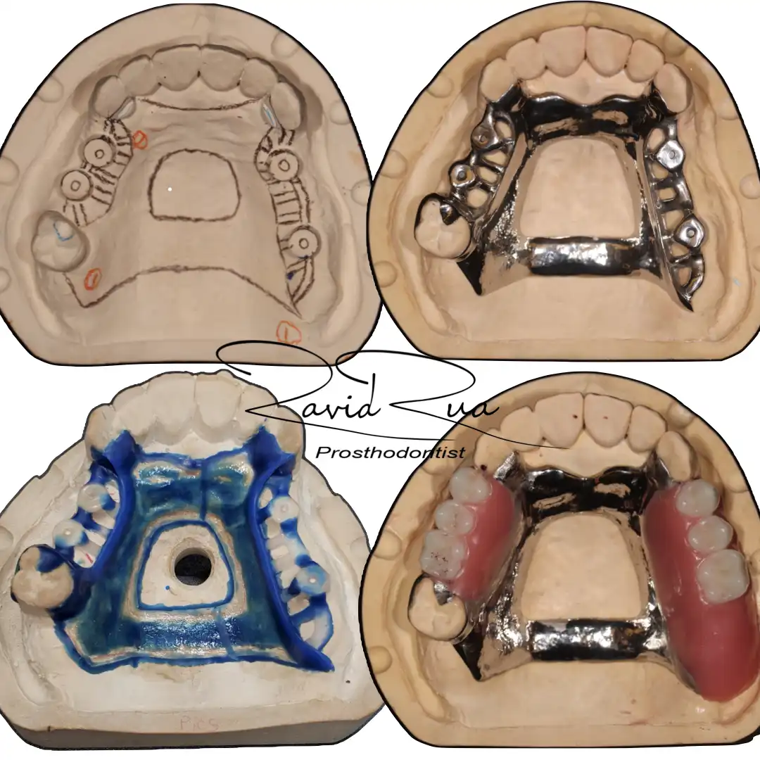 Patient #5(Top Partial Prosthesis supported by 4 implants and new crowns .002 copy