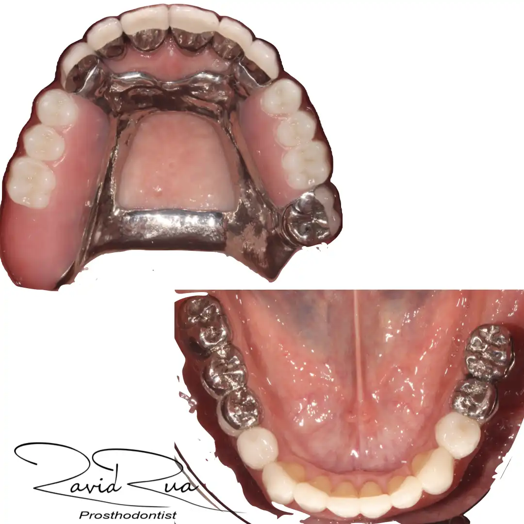 Patient #5(Top Partial Prosthesis supported by 4 implants and new crowns .003 copy