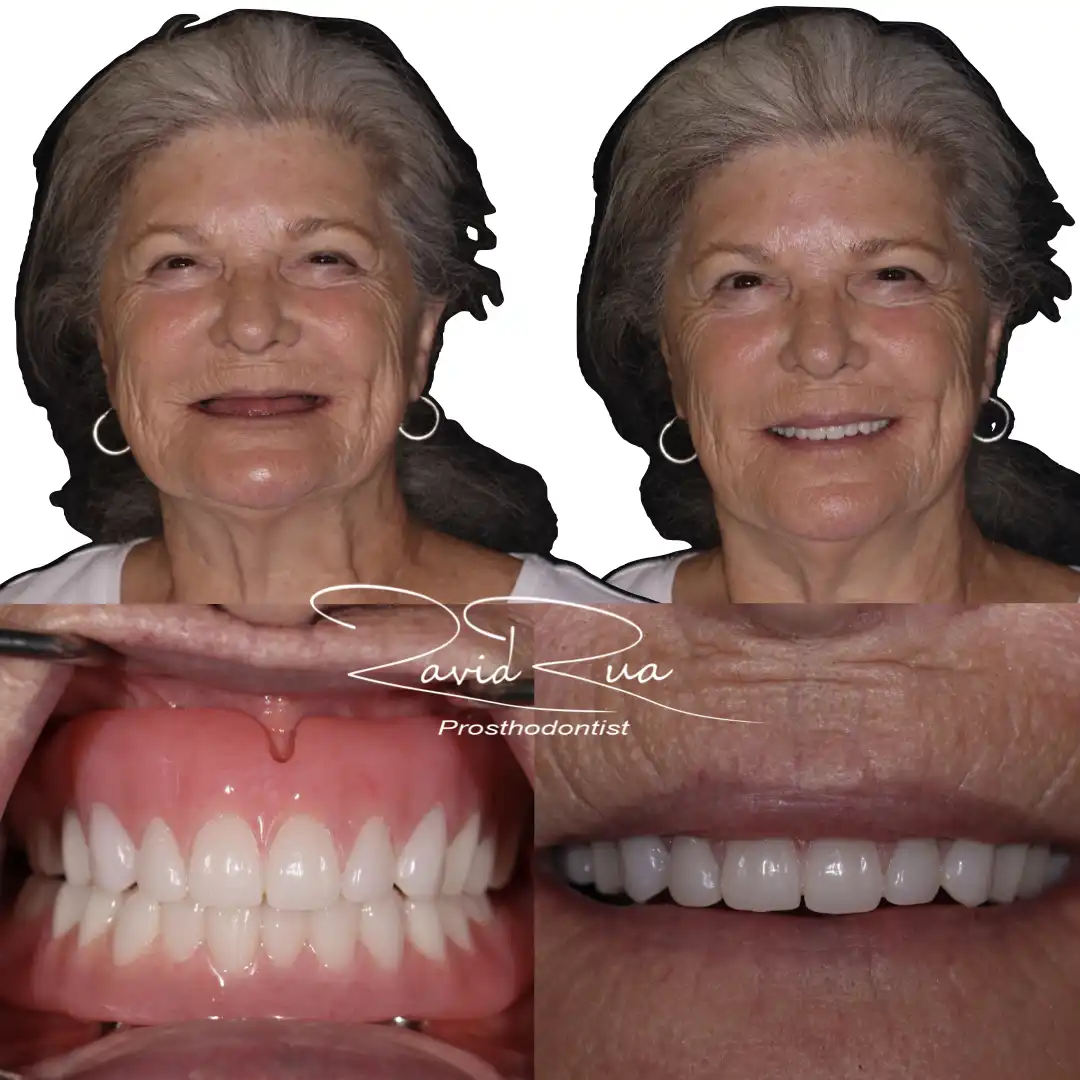 Patient #6 Top and bottom Titanium bars Overdentures supported by implants .001 copy