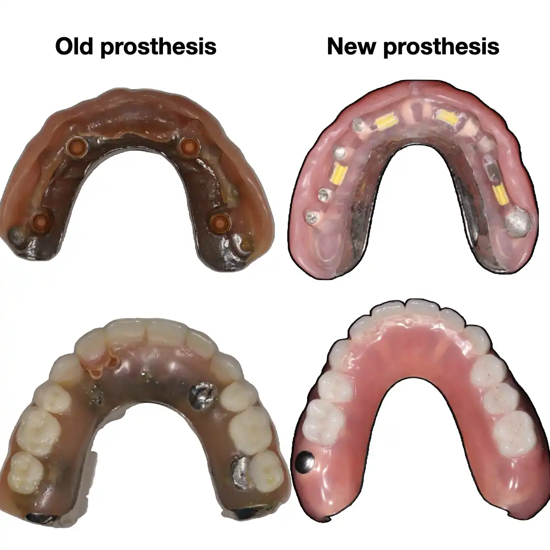 Patient #6 Top and bottom Titanium bars Overdentures supported by implants .002 copy