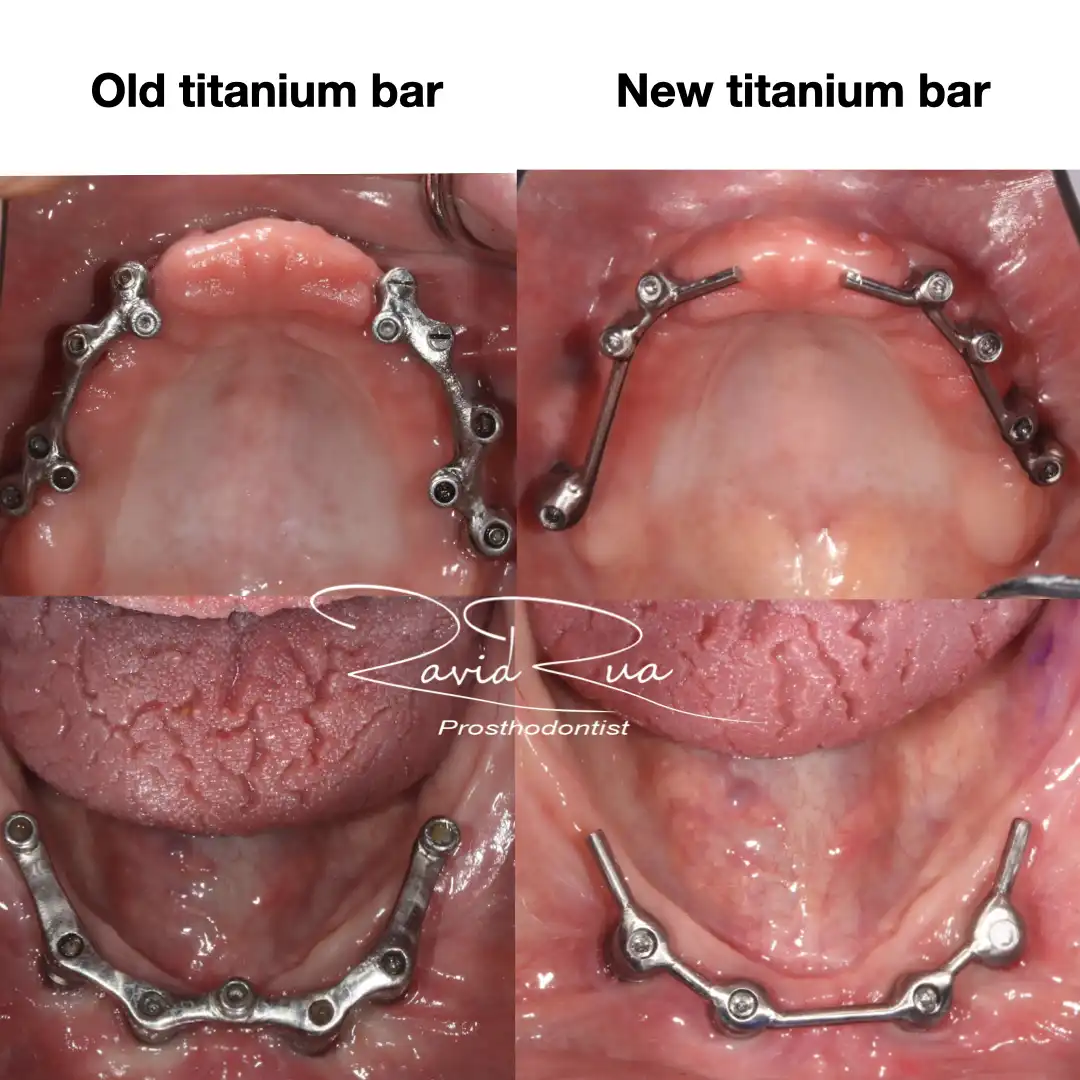 Patient #6 Top and bottom Titanium bars Overdentures supported by implants .003 copy