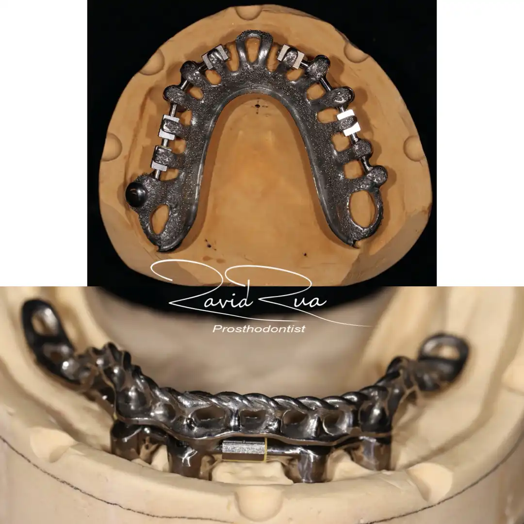 Patient #6 Top and bottom Titanium bars Overdentures supported by implants .004 copy