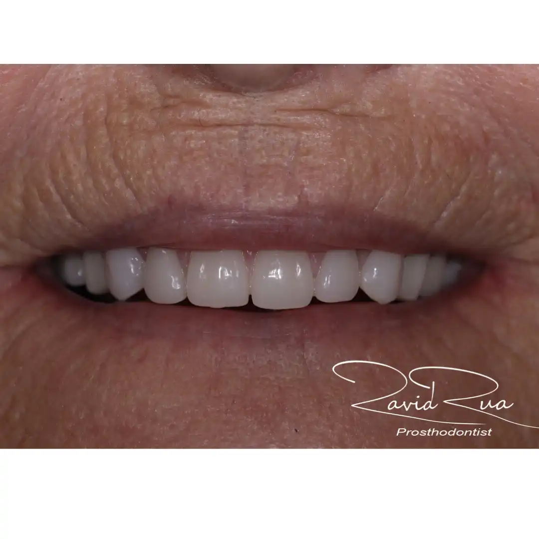 Patient #6 Top and bottom Titanium bars Overdentures supported by implants .005 copy