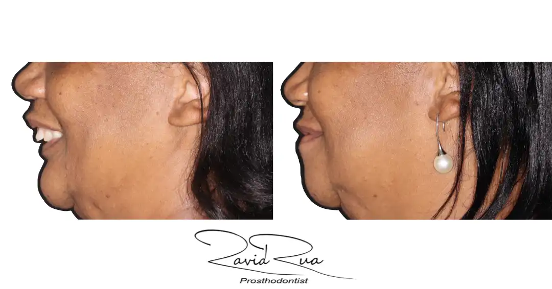 Patient #7 Rib graft and All on 4 Segmental Hybrid for a cancer survival patient .001 copy