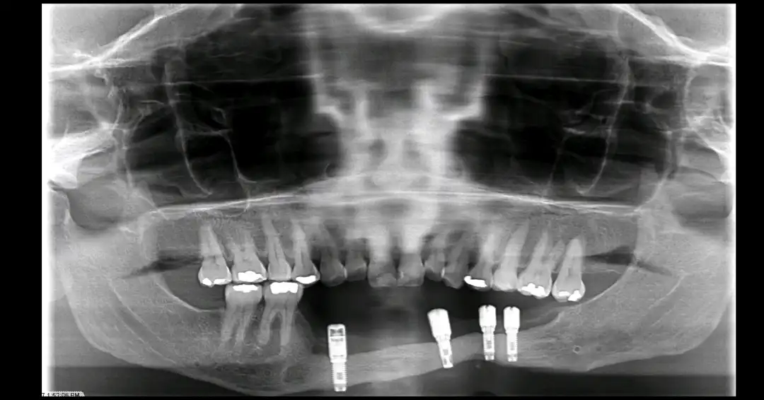 Patient #7 Rib graft and All on 4 Segmental Hybrid for a cancer survival patient .002 copy