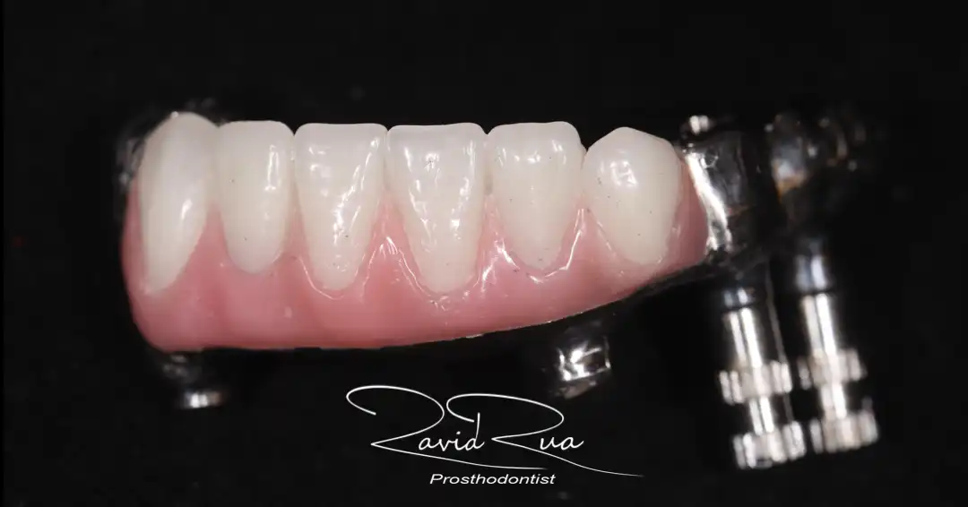 Patient #7 Rib graft and All on 4 Segmental Hybrid for a cancer survival patient .003 copy