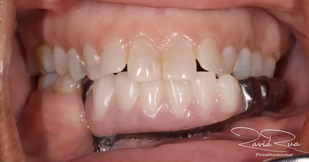 Patient #7 Rib graft and All on 4 Segmental Hybrid for a cancer survival patient .004 copy